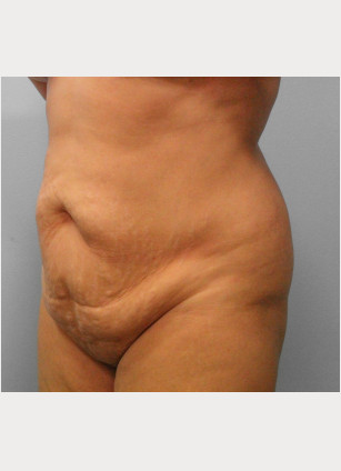 Before Image: Abdominoplasty & Lipo – Dr. Tucker - left-front-oblique