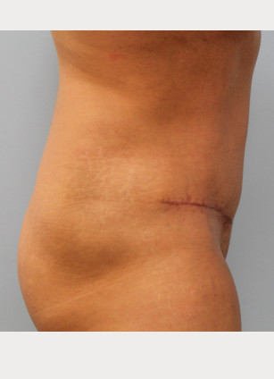 After Image: Abdominoplasty & Lipo – Dr. Tucker - right-side