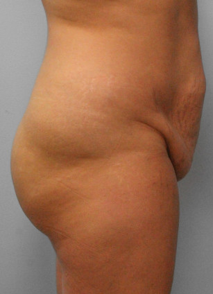 Before Image: Abdominoplasty & Lipo – Dr. Tucker - right-side