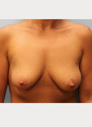 Before Image: Breast Augmentation- Dr. Tucker - front