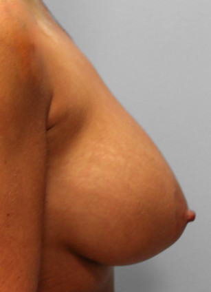 After Image: Breast Augmentation- Dr. Tucker - right-side