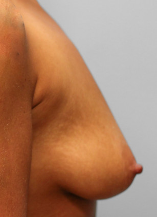 Before Image: Breast Augmentation- Dr. Tucker - right-side