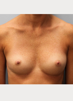 Before Image: Breast Augmentation- Dr. Tucker - front