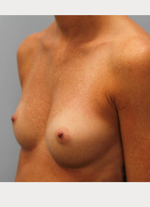 Before Image: Breast Augmentation- Dr. Tucker - left-front-oblique