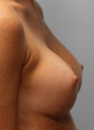 After Image: Breast Augmentation- Dr. Tucker - right-side
