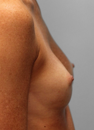 Before Image: Breast Augmentation- Dr. Tucker - right-side