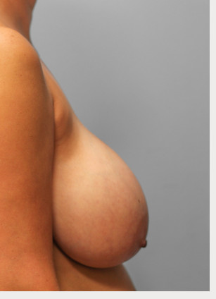 Before Image: Breast Reduction – Dr. Tucker - right-side