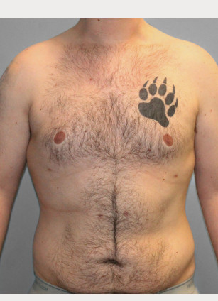 After Image: Gynecomastia- Dr. Tucker - front