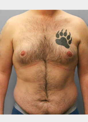 Before Image: Gynecomastia- Dr. Tucker - front