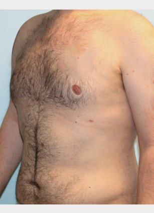 After Image: Gynecomastia- Dr. Tucker - left-front-oblique