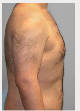 After Image: Gynecomastia- Dr. Tucker - right-side
