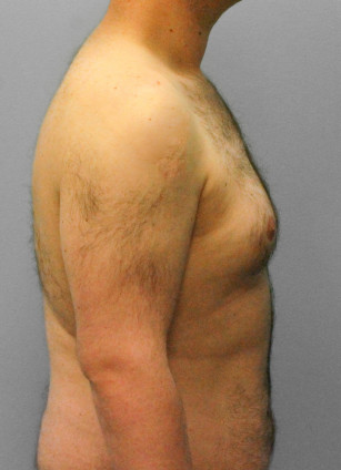 Before Image: Gynecomastia- Dr. Tucker - right-side