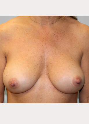 After Image: Breast Augmentation Revision- Dr. Tucker - front