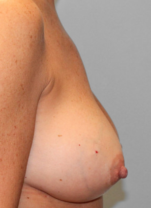 After Image: Breast Augmentation Revision- Dr. Tucker - right-side
