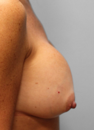 Before Image: Breast Augmentation Revision- Dr. Tucker - right-side