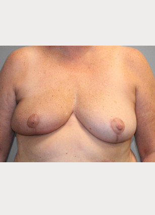 After Image: Breast Reconstruction- Dr. Tucker - front