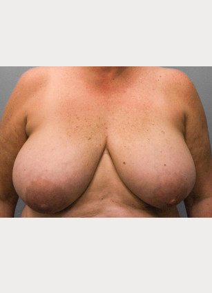 Before Image: Breast Reconstruction- Dr. Tucker - front