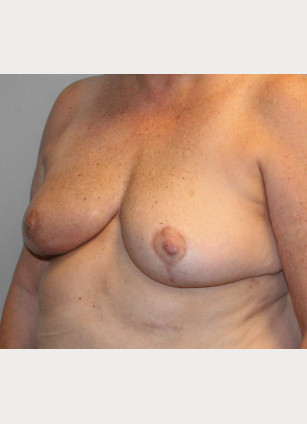 After Image: Breast Reconstruction- Dr. Tucker - left-front-oblique