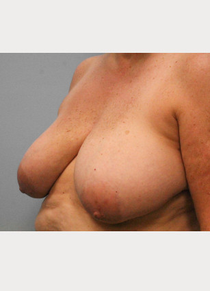 Before Image: Breast Reconstruction- Dr. Tucker - left-front-oblique