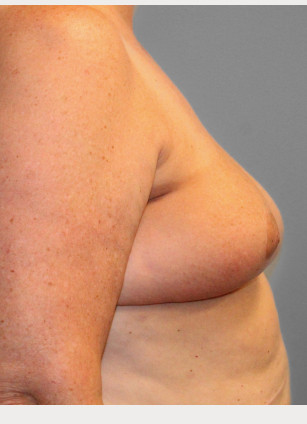 After Image: Breast Reconstruction- Dr. Tucker - right-side