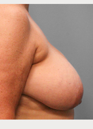 Before Image: Breast Reconstruction- Dr. Tucker - right-side