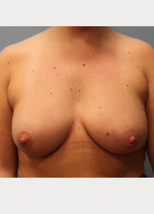 After Image: Breast Augmentation- Dr. Tucker - front