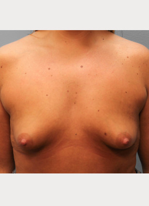 Before Image: Breast Augmentation- Dr. Tucker - front