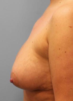 After Image: Breast Augmentation- Dr. Tucker - left-side