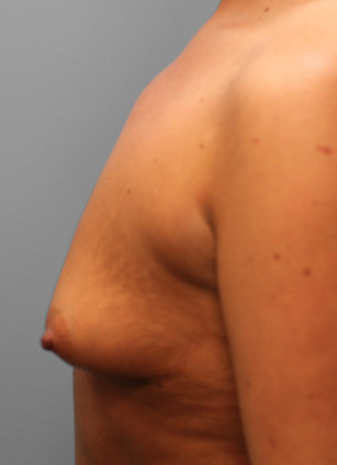 Before Image: Breast Augmentation- Dr. Tucker - left-side