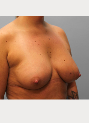 After Image: Breast Augmentation- Dr. Tucker - right-front-oblique