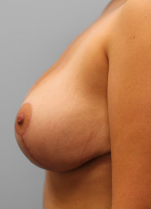 After Image: Breast Reduction – Dr. Tucker - left-side
