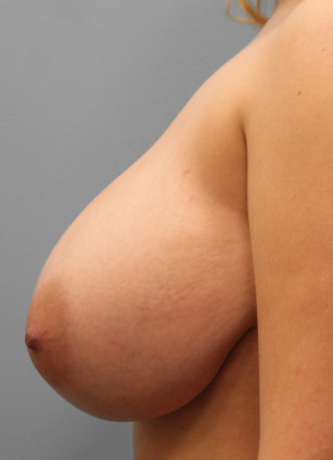 Before Image: Breast Reduction – Dr. Tucker - left-side