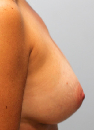 After Image: Breast Augmentation – Dr. Tucker - right-side