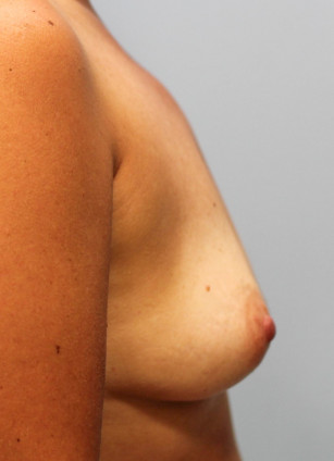 Before Image: Breast Augmentation – Dr. Tucker - right-side