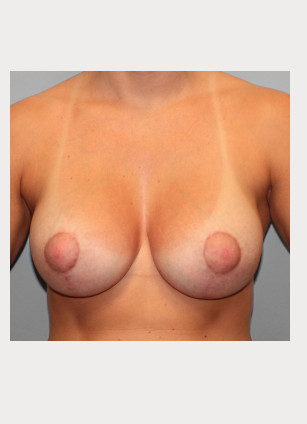 After Image: Breast Augmentation- Dr. Tucker - front