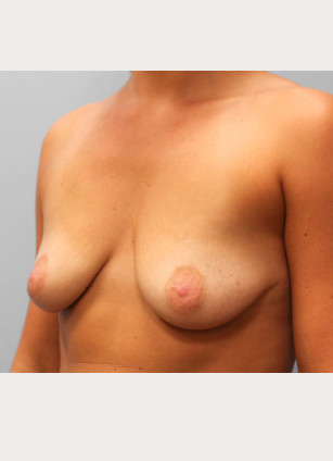 Before Image: Breast Augmentation- Dr. Tucker - left-front-oblique