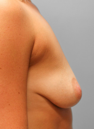 Before Image: Breast Augmentation- Dr. Tucker - right-side