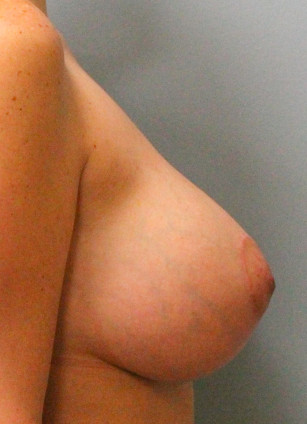 After Image: Breast Lift- Dr. Tucker - right-side