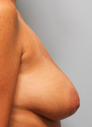 Before Image: Breast Lift- Dr. Tucker - right-side