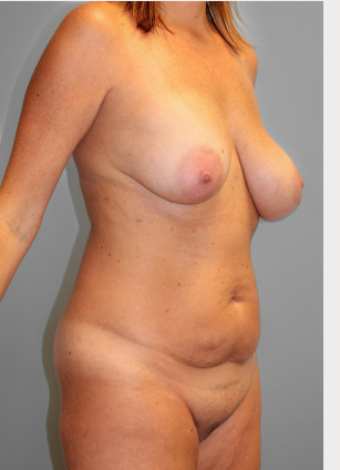 Before Image: Mommy Makeover – Dr. Tucker - right-front-oblique