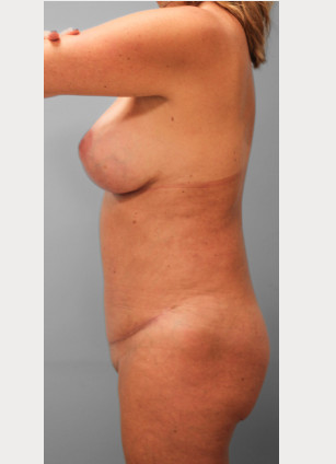 After Image: Mommy Makeover – Dr. Tucker - left-side
