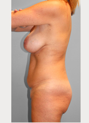 Before Image: Mommy Makeover – Dr. Tucker - left-side