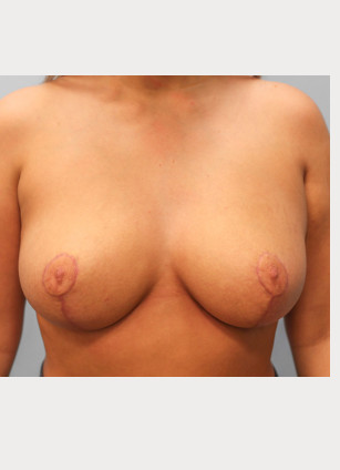 After Image: Breast Reduction – Dr. Tucker - front