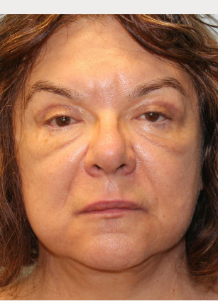After Image: Facelift & Blepharoplasty – Dr. Tucker - front