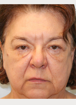 Before Image: Facelift & Blepharoplasty – Dr. Tucker - front