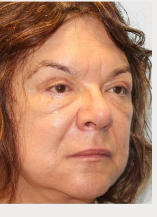 After Image: Facelift & Blepharoplasty – Dr. Tucker - right-front-oblique