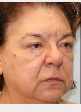Before Image: Facelift & Blepharoplasty – Dr. Tucker - right-front-oblique