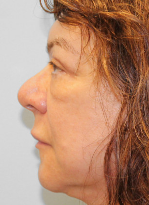 After Image: Facelift & Blepharoplasty – Dr. Tucker - left-side