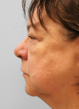 Before Image: Facelift & Blepharoplasty – Dr. Tucker - left-side