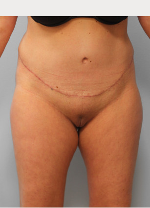 After Image: Abdominoplasty & Lipo – Dr. Tucker - front